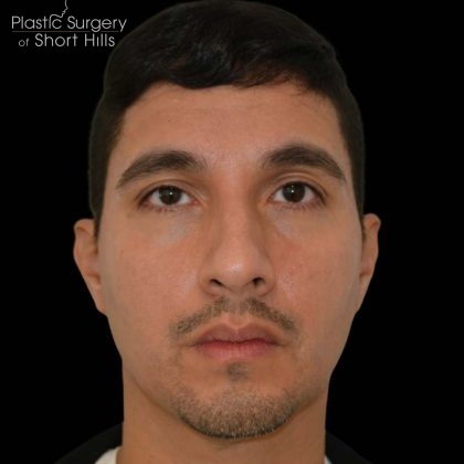 Rhinoplasty Before & After Patient #16196