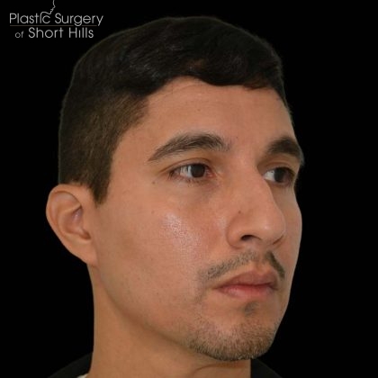 Rhinoplasty Before & After Patient #16196