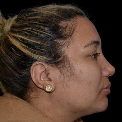 Rhinoplasty Before & After Patient #16191