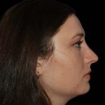 Rhinoplasty Before & After Patient #16184