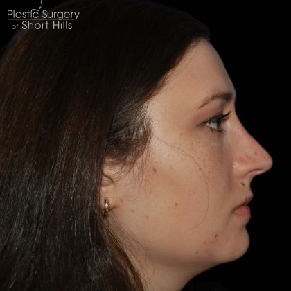 Rhinoplasty Before & After Patient #16184