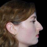 Rhinoplasty Before & After Patient #16184