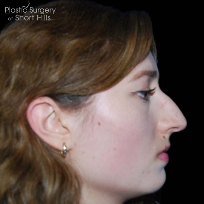 Rhinoplasty Before & After Patient #16184