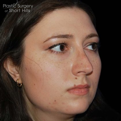 Rhinoplasty Before & After Patient #16184