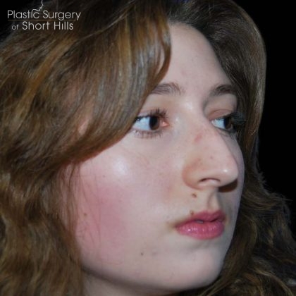 Rhinoplasty Before & After Patient #16184