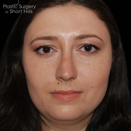 Rhinoplasty Before & After Patient #16184