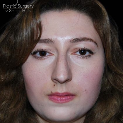 Rhinoplasty Before & After Patient #16184