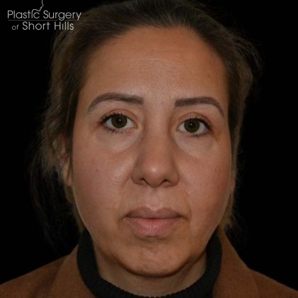 Blepharoplasty Before & After Patient #16227