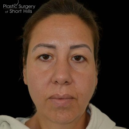 Blepharoplasty Before & After Patient #16227