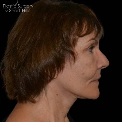 Facelift Before & After Patient #16238