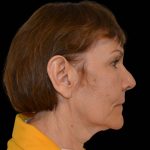Facelift Before & After Patient #16238