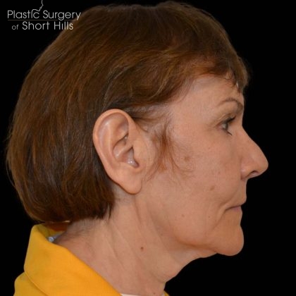 Facelift Before & After Patient #16238