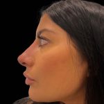 Liquid Rhinoplasty(Non-Surgical) Before & After Patient #16243