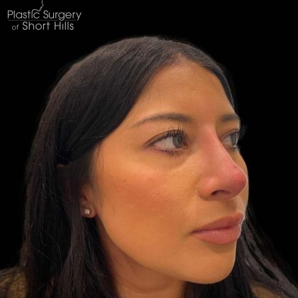 Liquid Rhinoplasty(Non-Surgical) Before & After Patient #16243