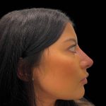 Liquid Rhinoplasty(Non-Surgical) Before & After Patient #16243