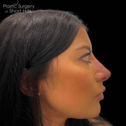 Liquid Rhinoplasty(Non-Surgical) Before & After Patient #16243