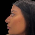 Liquid Rhinoplasty(Non-Surgical) Before & After Patient #16243