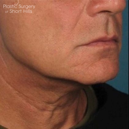 Ultherapy Before & After Patient #16257