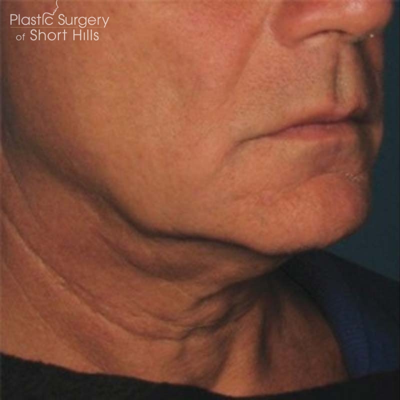 Ultherapy Before & After Patient #16257