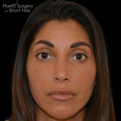 Revision Rhinoplasty Before & After Patient #16320