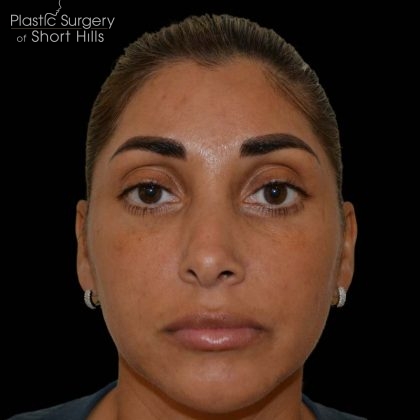 Revision Rhinoplasty Before & After Patient #16320