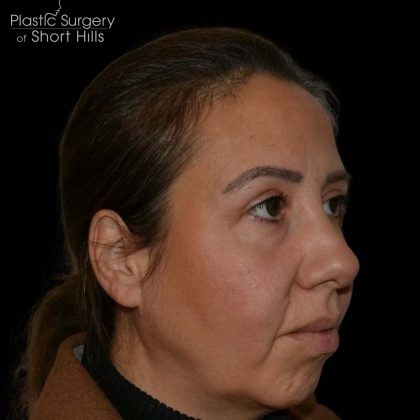 Blepharoplasty Before & After Patient #16227