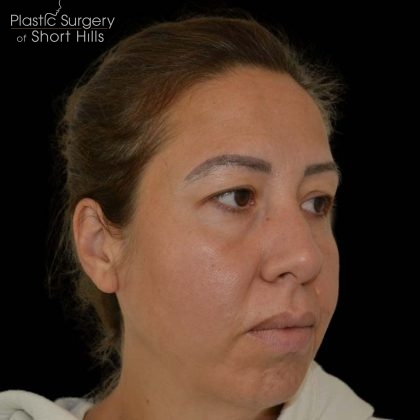 Blepharoplasty Before & After Patient #16227