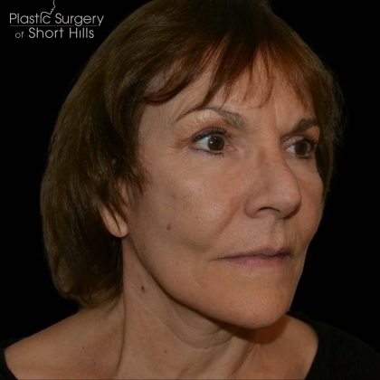 Facelift Before & After Patient #16238