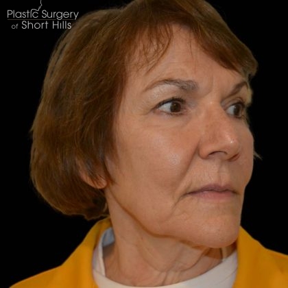 Facelift Before & After Patient #16238