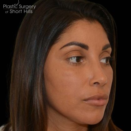Revision Rhinoplasty Before & After Patient #16320