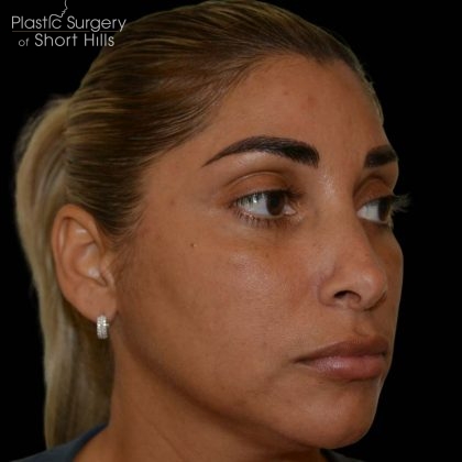 Revision Rhinoplasty Before & After Patient #16320