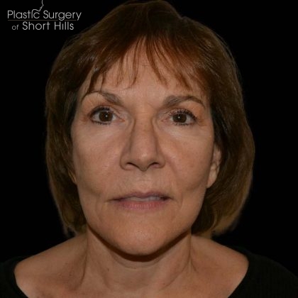 Facelift Before & After Patient #16238