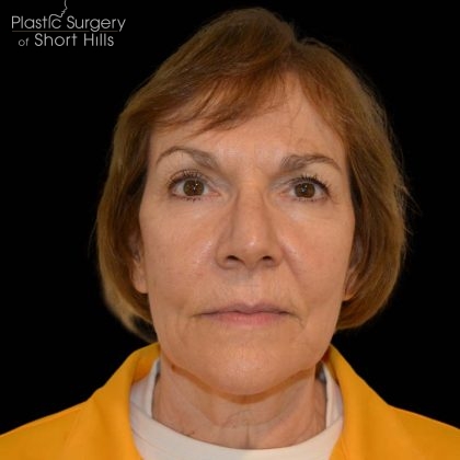 Facelift Before & After Patient #16238