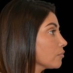 Revision Rhinoplasty Before & After Patient #16320