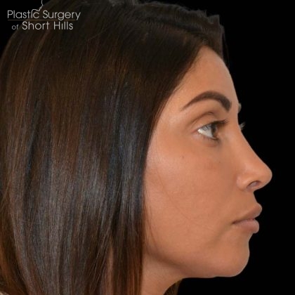 Revision Rhinoplasty Before & After Patient #16320