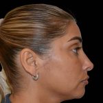 Revision Rhinoplasty Before & After Patient #16320