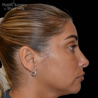 Revision Rhinoplasty Before & After Patient #16320