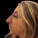 Liquid Rhinoplasty(Non-Surgical) Before & After Patient #16246