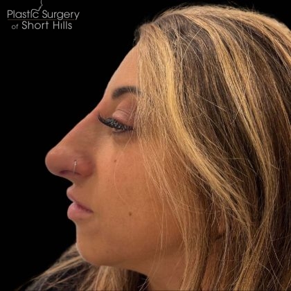 Liquid Rhinoplasty(Non-Surgical) Before & After Patient #16246
