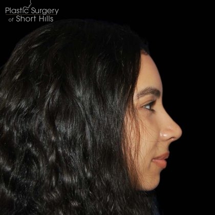Rhinoplasty Before & After Patient #16217
