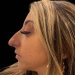 Liquid Rhinoplasty(Non-Surgical) Before & After Patient #16246