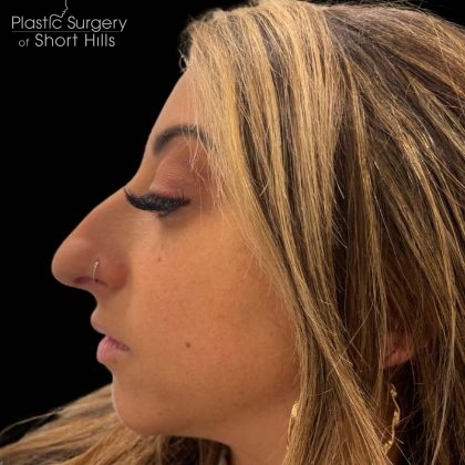 Liquid Rhinoplasty(Non-Surgical) Before & After Patient #16246