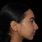 Rhinoplasty Before & After Patient #16217