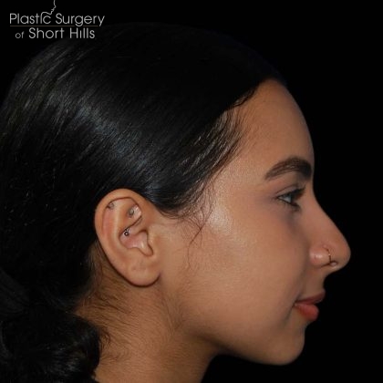 Rhinoplasty Before & After Patient #16217