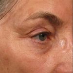 Ultherapy Before & After Patient #16256