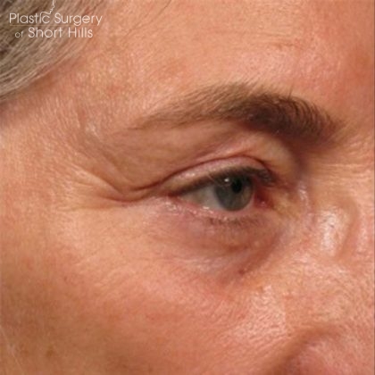 Ultherapy Before & After Patient #16256