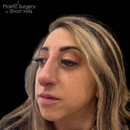 Liquid Rhinoplasty(Non-Surgical) Before & After Patient #16246