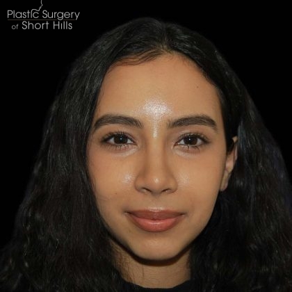 Rhinoplasty Before & After Patient #16217