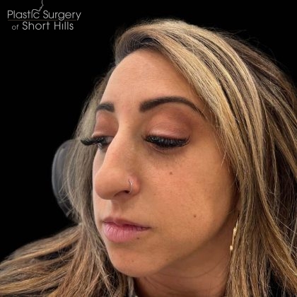 Liquid Rhinoplasty(Non-Surgical) Before & After Patient #16246