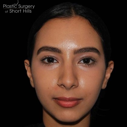 Rhinoplasty Before & After Patient #16217